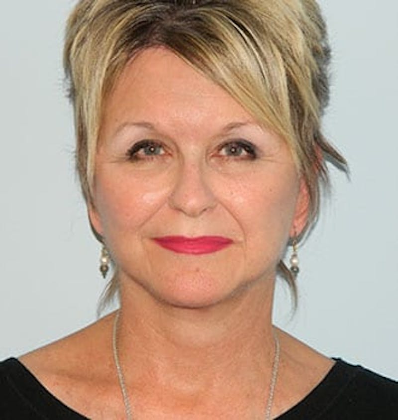 Mini-Facelift Before & After Gallery - Patient 133066573 - Image 4