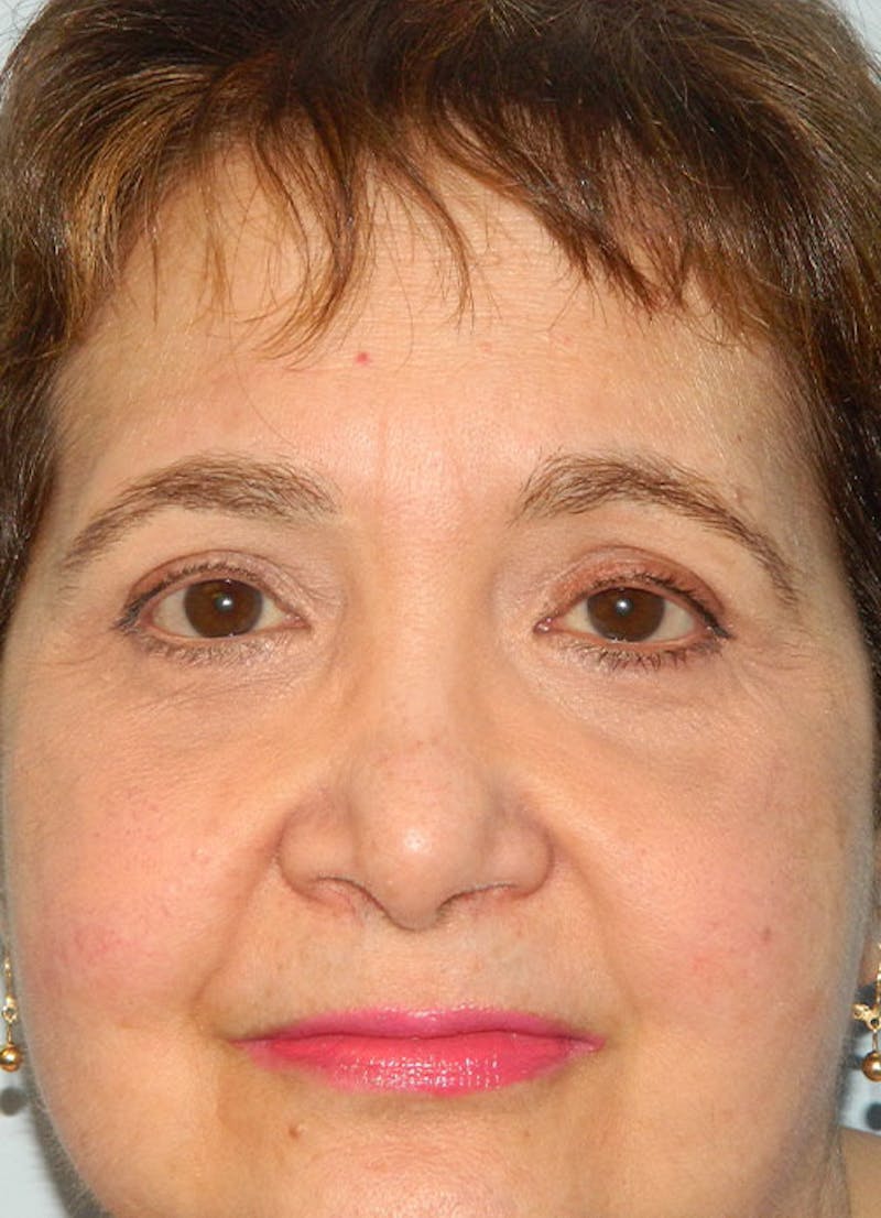 Blepharoplasty (Eyelid Lift) Before & After Gallery - Patient 133066574 - Image 2