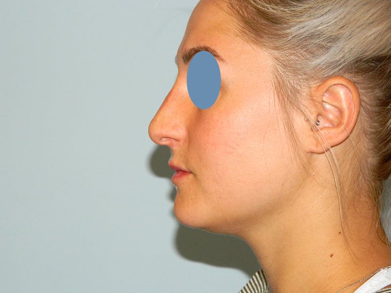Non-Surgical Rhinoplasty and Injectable Fillers Before & After Gallery - Patient 133066577 - Image 2
