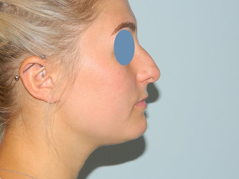 Non-Surgical Rhinoplasty and Injectable Fillers Before & After Gallery - Patient 133066577 - Image 3