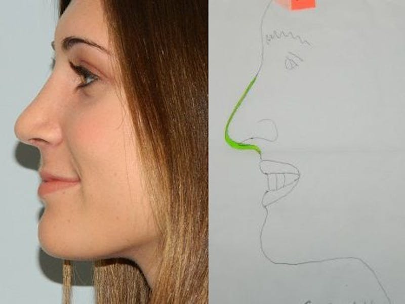Rhinoplasty Before & After Gallery - Patient 133066581 - Image 2