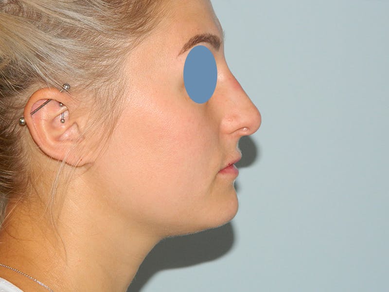 Non-Surgical Rhinoplasty and Injectable Fillers Before & After Gallery - Patient 133066577 - Image 4