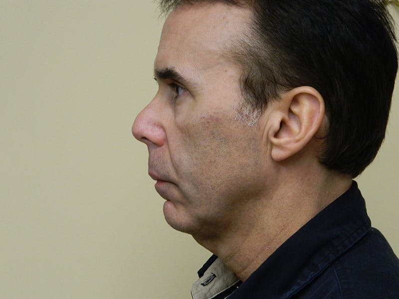 Chin Augmentation Before & After Gallery - Patient 133066579 - Image 1