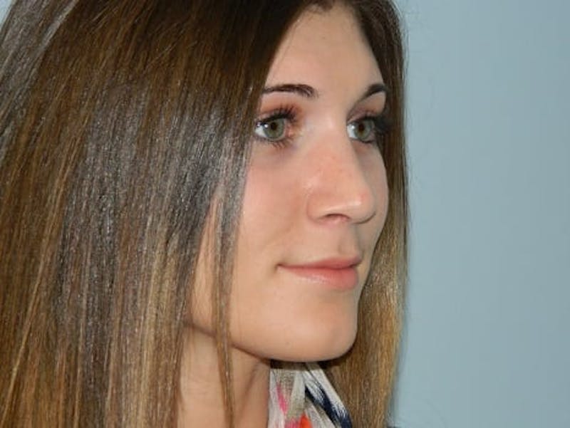 Rhinoplasty Before & After Gallery - Patient 133066581 - Image 4