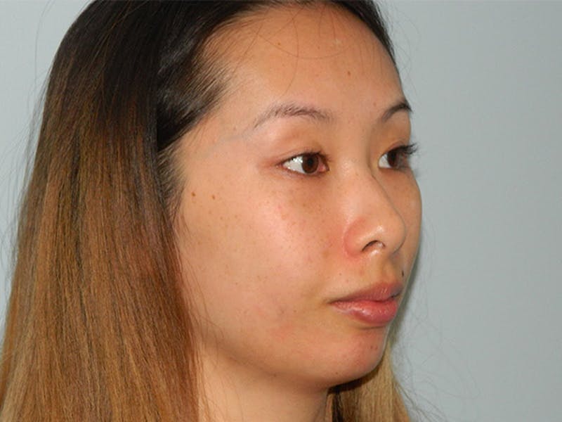 Non-Surgical Rhinoplasty and Injectable Fillers Before & After Gallery - Patient 133066578 - Image 1