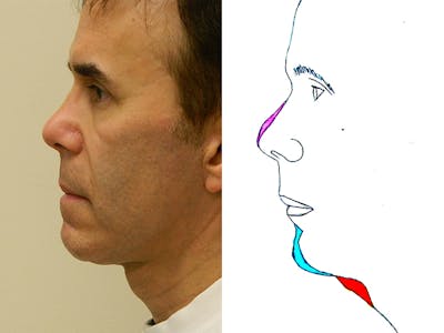 Chin Augmentation Before & After Gallery - Patient 133066579 - Image 2