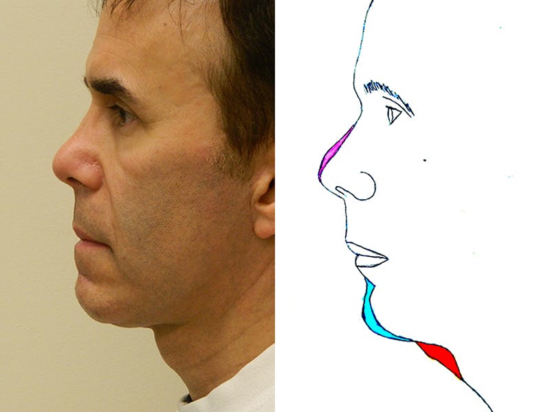Chin Augmentation Before & After Gallery - Patient 133066579 - Image 2