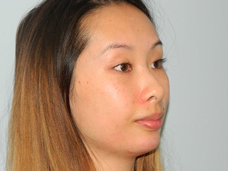 Non-Surgical Rhinoplasty and Injectable Fillers Before & After Gallery - Patient 133066578 - Image 2