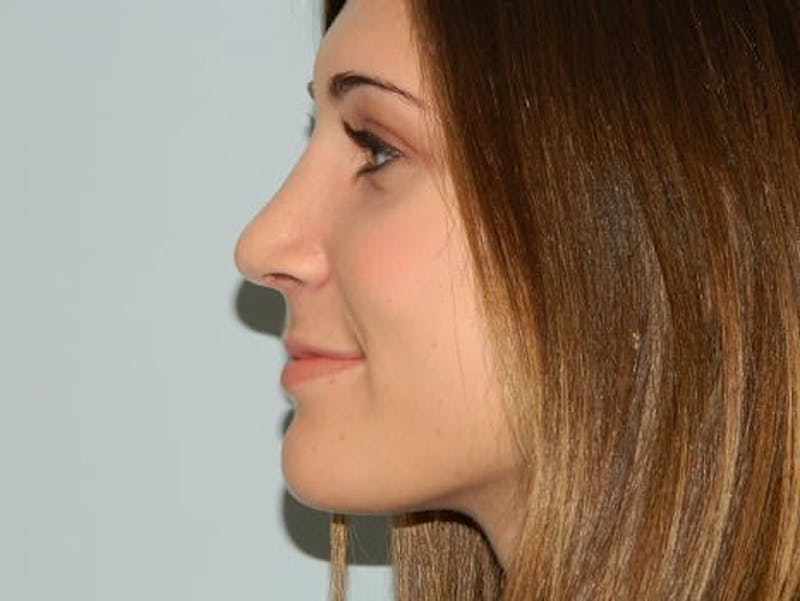 Rhinoplasty Before & After Gallery - Patient 133066581 - Image 6