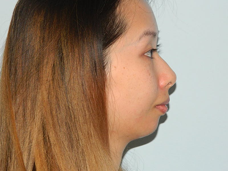 Non-Surgical Rhinoplasty and Injectable Fillers Before & After Gallery - Patient 133066578 - Image 3