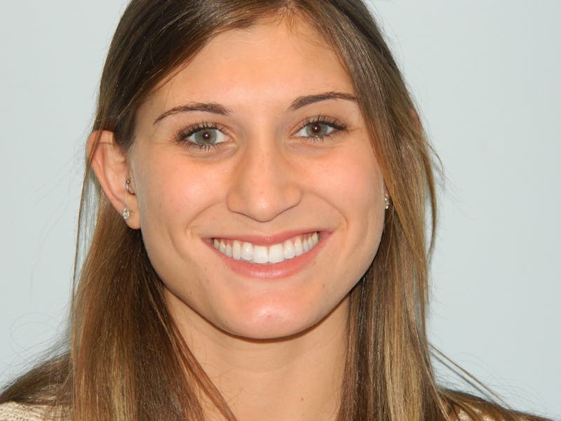 Rhinoplasty Before & After Gallery - Patient 133066581 - Image 7