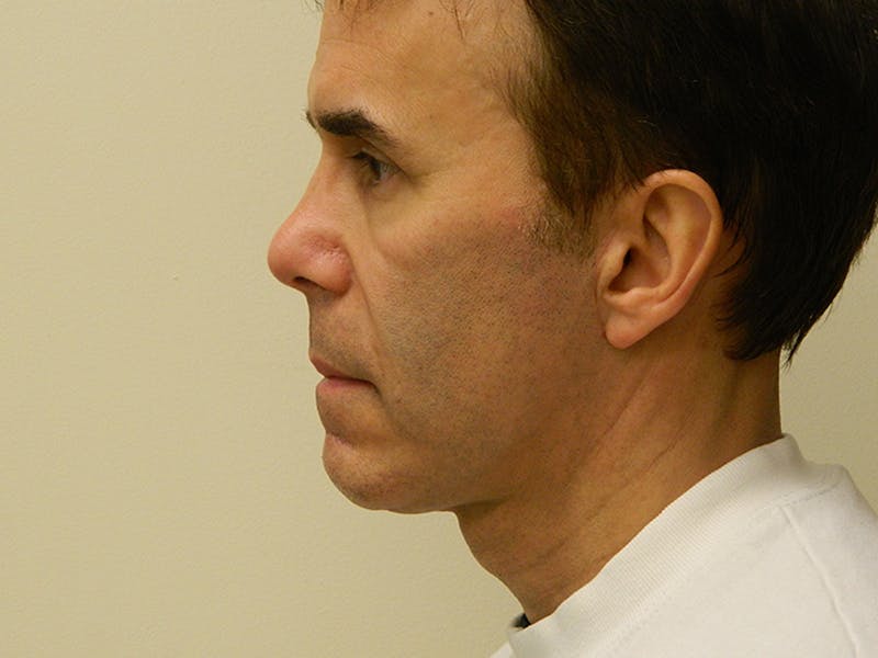 Chin Augmentation Before & After Gallery - Patient 133066579 - Image 4