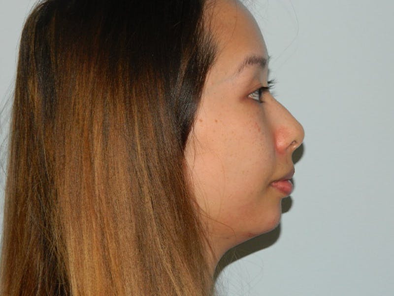 Non-Surgical Rhinoplasty and Injectable Fillers Before & After Gallery - Patient 133066578 - Image 4