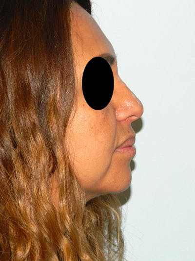 Non-Surgical Rhinoplasty and Injectable Fillers Before & After Gallery - Patient 133066580 - Image 1