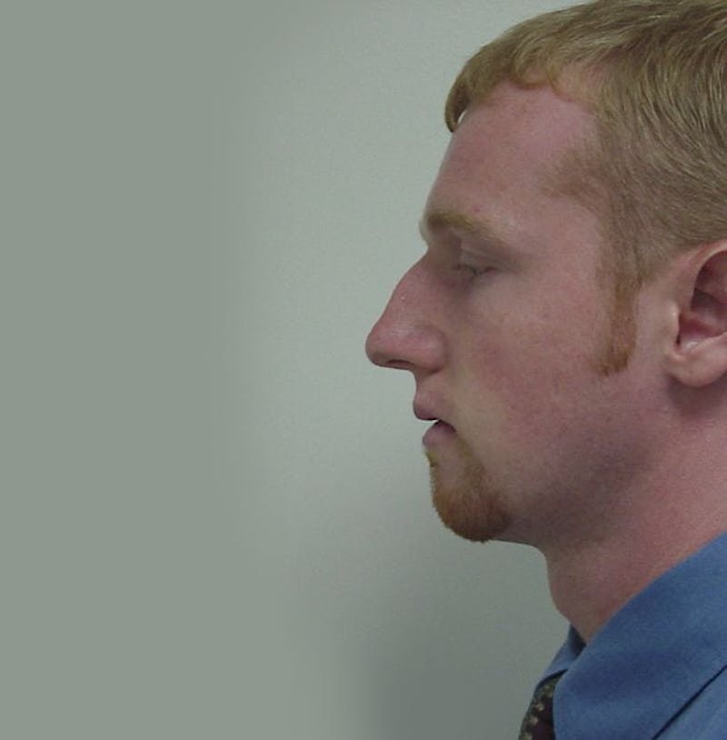 Chin Augmentation Before & After Gallery - Patient 133066582 - Image 1