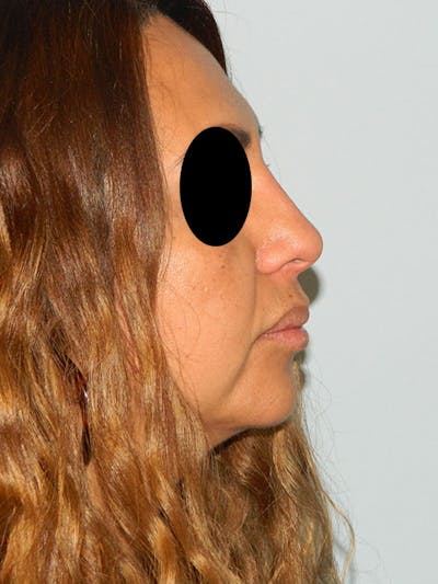 Non-Surgical Rhinoplasty and Injectable Fillers Before & After Gallery - Patient 133066580 - Image 2