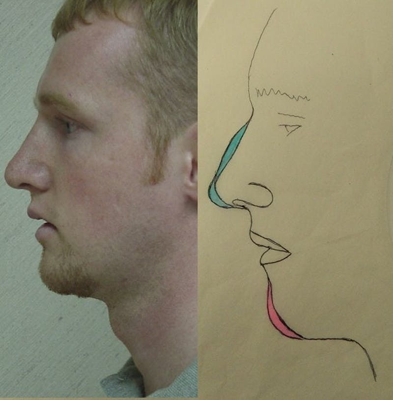 Chin Augmentation Before & After Gallery - Patient 133066582 - Image 2