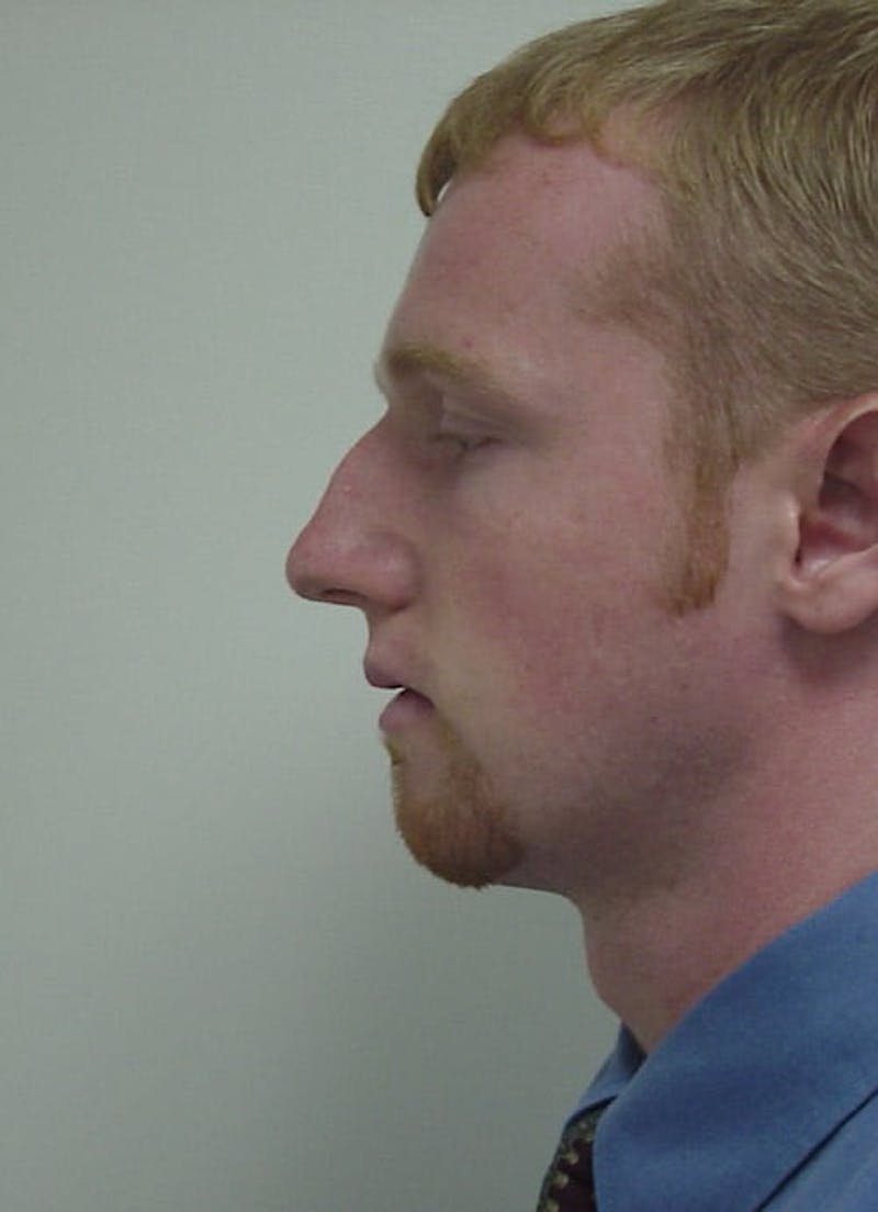 Chin Augmentation Before & After Gallery - Patient 133066582 - Image 3