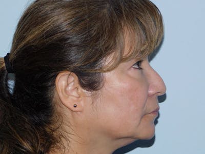 Rhinoplasty Before & After Gallery - Patient 133066583 - Image 1