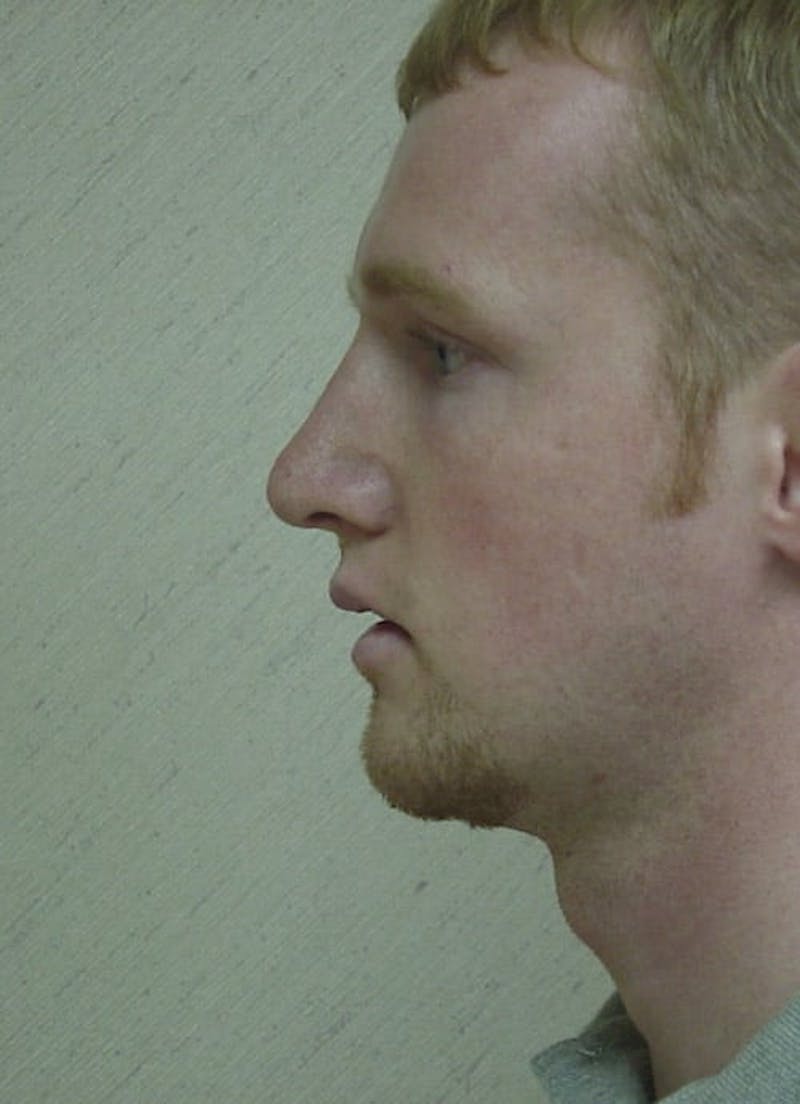 Chin Augmentation Before & After Gallery - Patient 133066582 - Image 4
