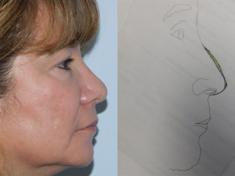 Rhinoplasty Before & After Gallery - Patient 133066583 - Image 2