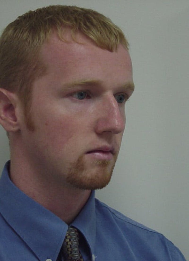 Chin Augmentation Before & After Gallery - Patient 133066582 - Image 5