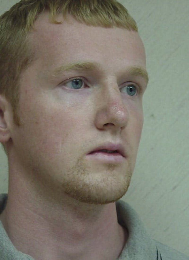 Chin Augmentation Before & After Gallery - Patient 133066582 - Image 6