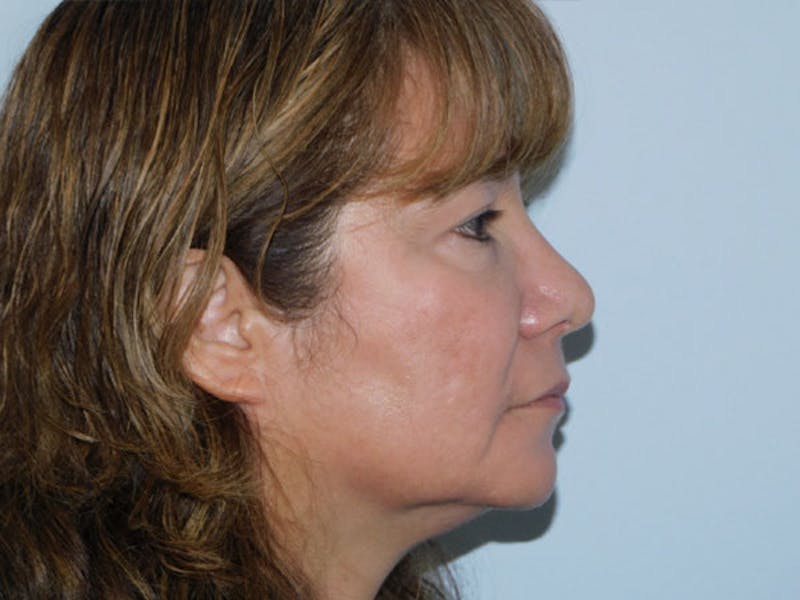 Rhinoplasty Before & After Gallery - Patient 133066583 - Image 4