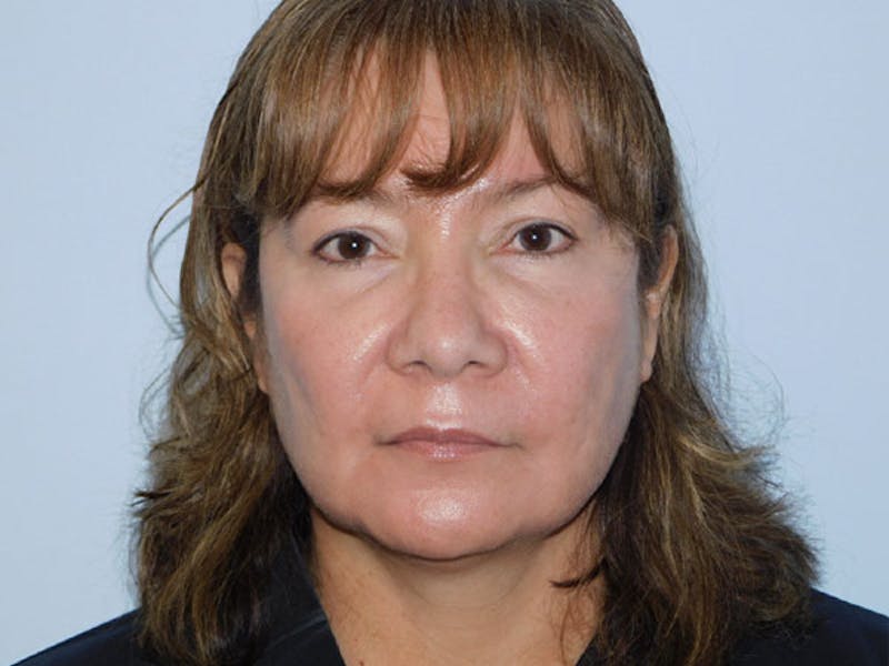 Rhinoplasty Before & After Gallery - Patient 133066583 - Image 5