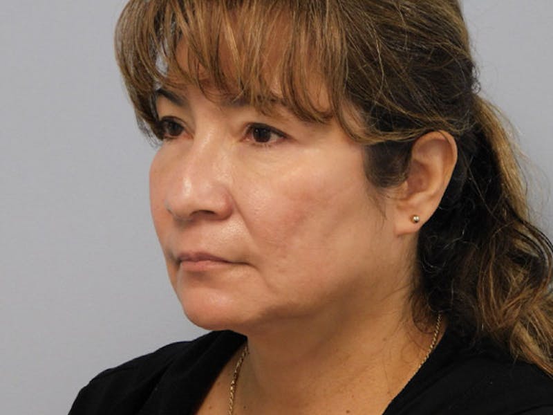 Rhinoplasty Before & After Gallery - Patient 133066583 - Image 7