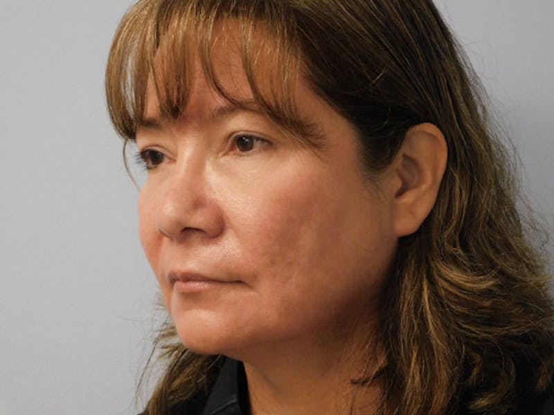 Rhinoplasty Before & After Gallery - Patient 133066583 - Image 8