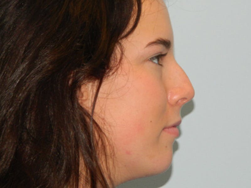 Rhinoplasty Before & After Gallery - Patient 133066584 - Image 1