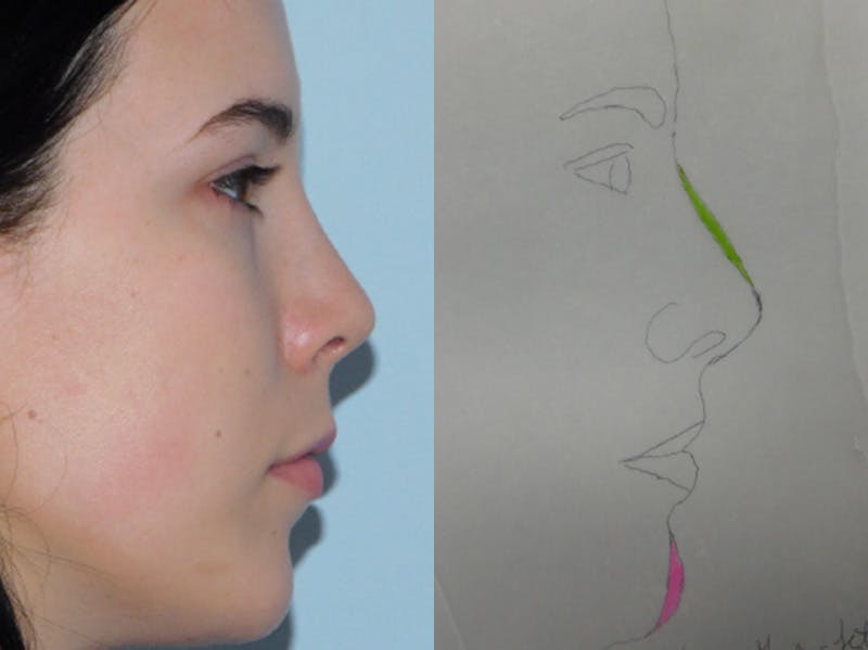 Rhinoplasty Before & After Gallery - Patient 133066584 - Image 2