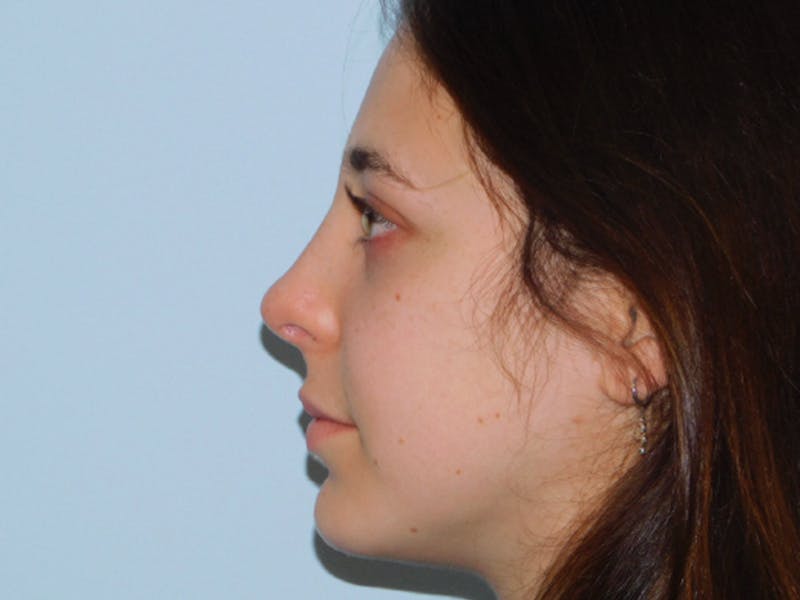 Chin Augmentation Before & After Gallery - Patient 133066585 - Image 4
