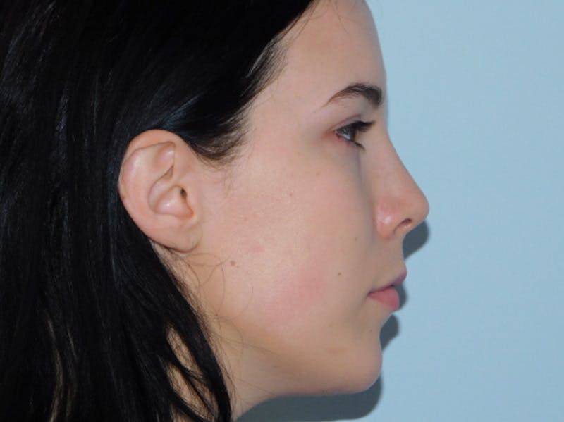 Rhinoplasty Before & After Gallery - Patient 133066584 - Image 4