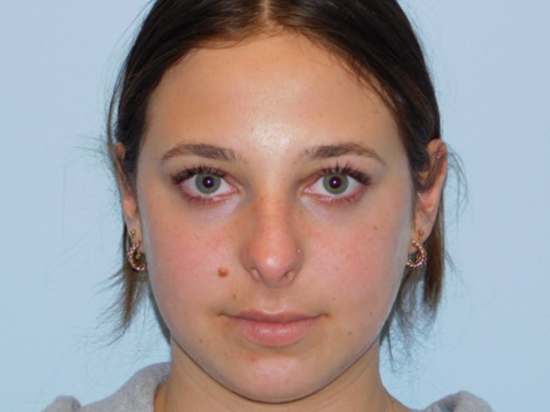 Chin Augmentation Before & After Gallery - Patient 133066585 - Image 5