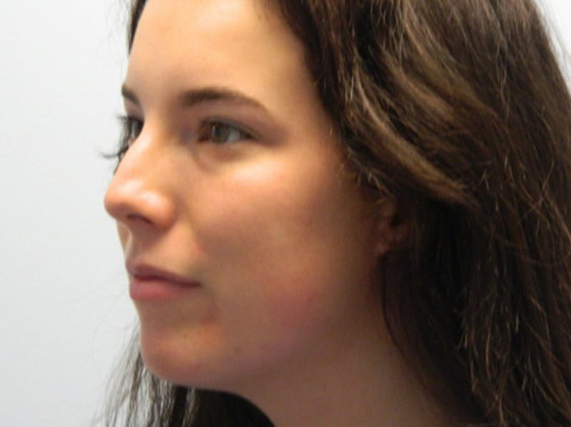 Rhinoplasty Before & After Gallery - Patient 133066584 - Image 5