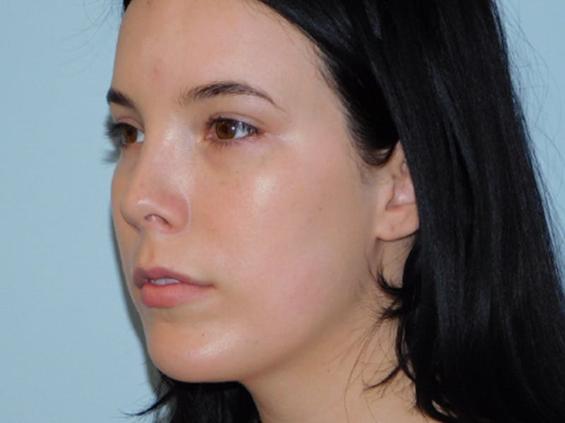 Rhinoplasty Before & After Gallery - Patient 133066584 - Image 6