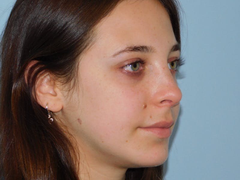 Chin Augmentation Before & After Gallery - Patient 133066585 - Image 8