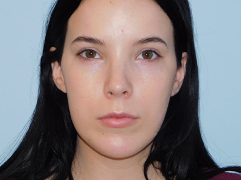 Rhinoplasty Before & After Gallery - Patient 133066584 - Image 8