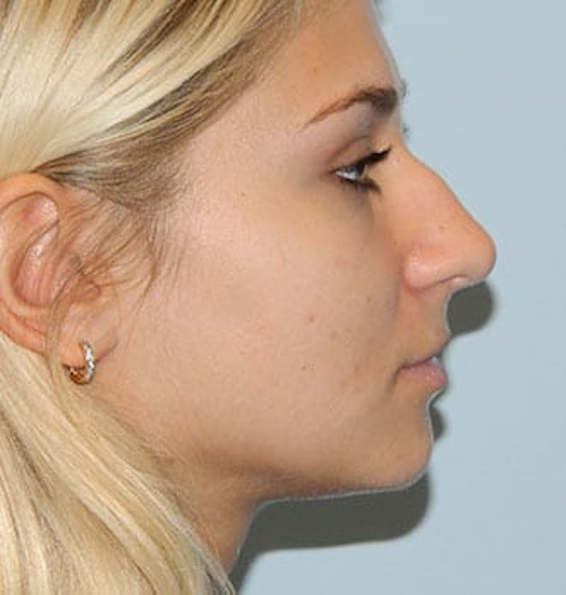 Rhinoplasty Before & After Gallery - Patient 133066586 - Image 1