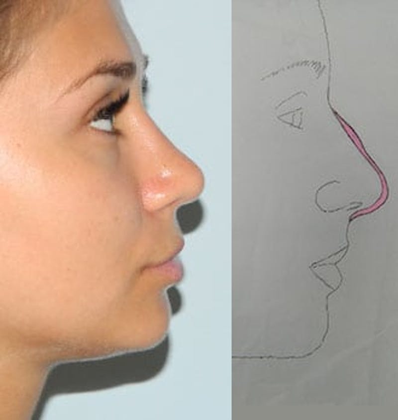Rhinoplasty Before & After Gallery - Patient 133066586 - Image 2