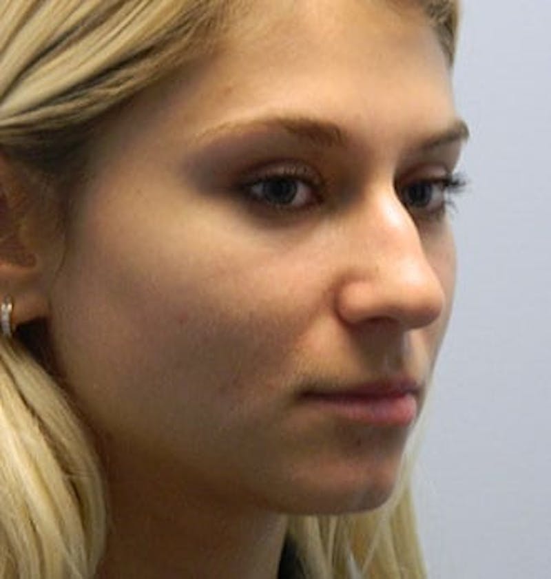 Rhinoplasty Before & After Gallery - Patient 133066586 - Image 3