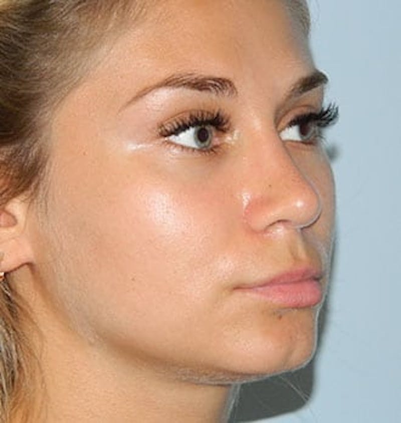 Rhinoplasty Before & After Gallery - Patient 133066586 - Image 4