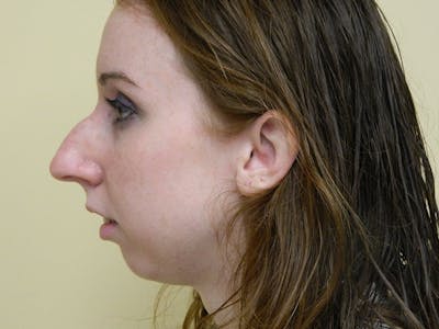 Chin Augmentation Before & After Gallery - Patient 133066587 - Image 1