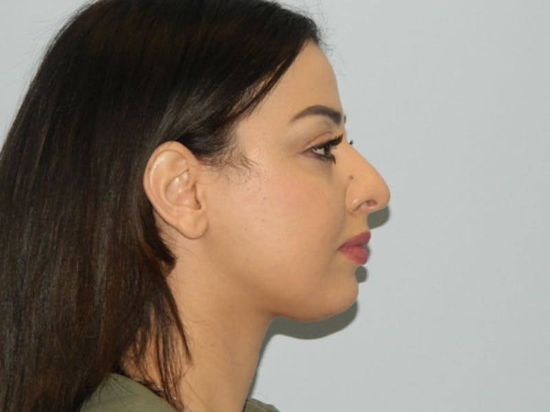 Rhinoplasty Before & After Gallery - Patient 133066588 - Image 1