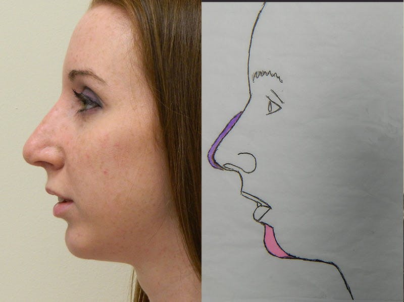 Chin Augmentation Before & After Gallery - Patient 133066587 - Image 2