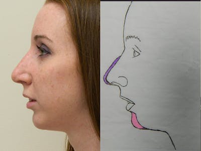 Chin Augmentation Before & After Gallery - Patient 133066587 - Image 2