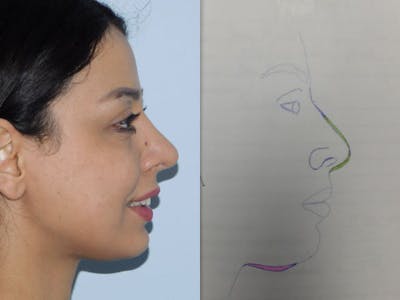 Rhinoplasty Before & After Gallery - Patient 133066588 - Image 2
