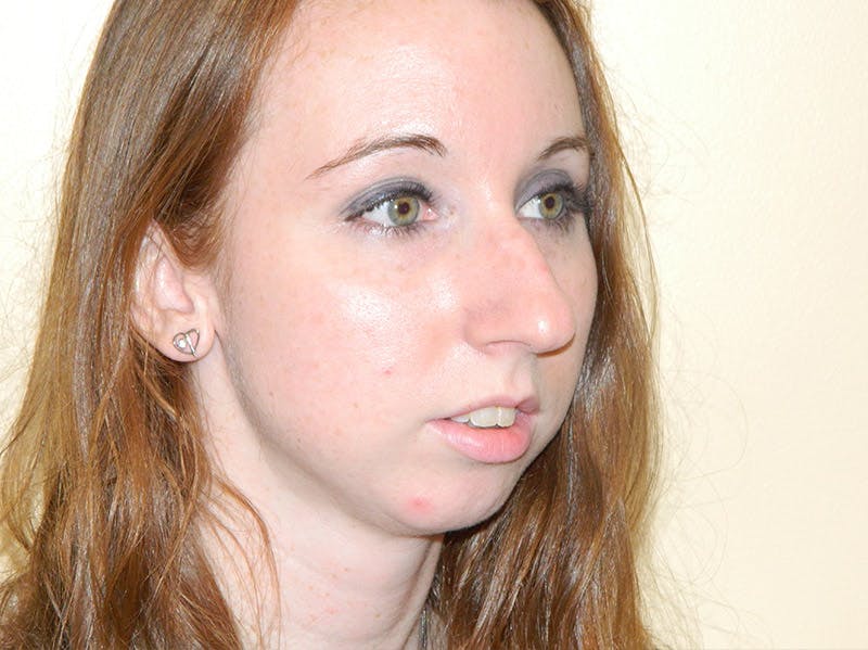 Chin Augmentation Before & After Gallery - Patient 133066587 - Image 5